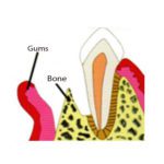 gtr6|gtr|gtr4|bone|grafts