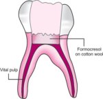 DentGist Buckley’s Formocresol|cd243e24-249d-430a-a132-675a02fb9bfb|113-1