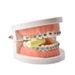 Captain Ortho Chewies for Aligner 20/pk|aligner-chewies|soft-chews-orthodontic-invisible-braces-dental-aligner-chewies|51g213eqtll._sl1001_|screenshot_2023-03-24_162930