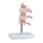 Divine Medicare – Cutaway Osteoporosis Anatomical Model