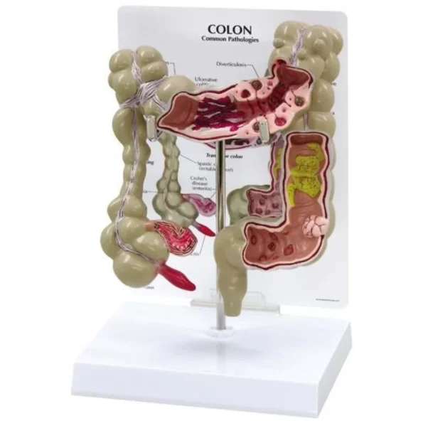 Divine Medicare - Colon Pathological Model Showing Various Pathologies