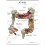 Divine Medicare – Colon Pathological Model Showing Various Pathologies|colon-model-pathological02-1200×1200