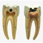 Dental Caries Model