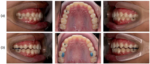 Anabond Blu-Bite|blu-bite-composite|intraoral-photos-a-before-and-b|tecnica-levante-de-mordida-en-ortodoncia