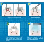 Bisco TheraCal PT DC Resin Modified Calcium Silicate Material|theracal_4|theracal_1|theracal_3|thercal_5